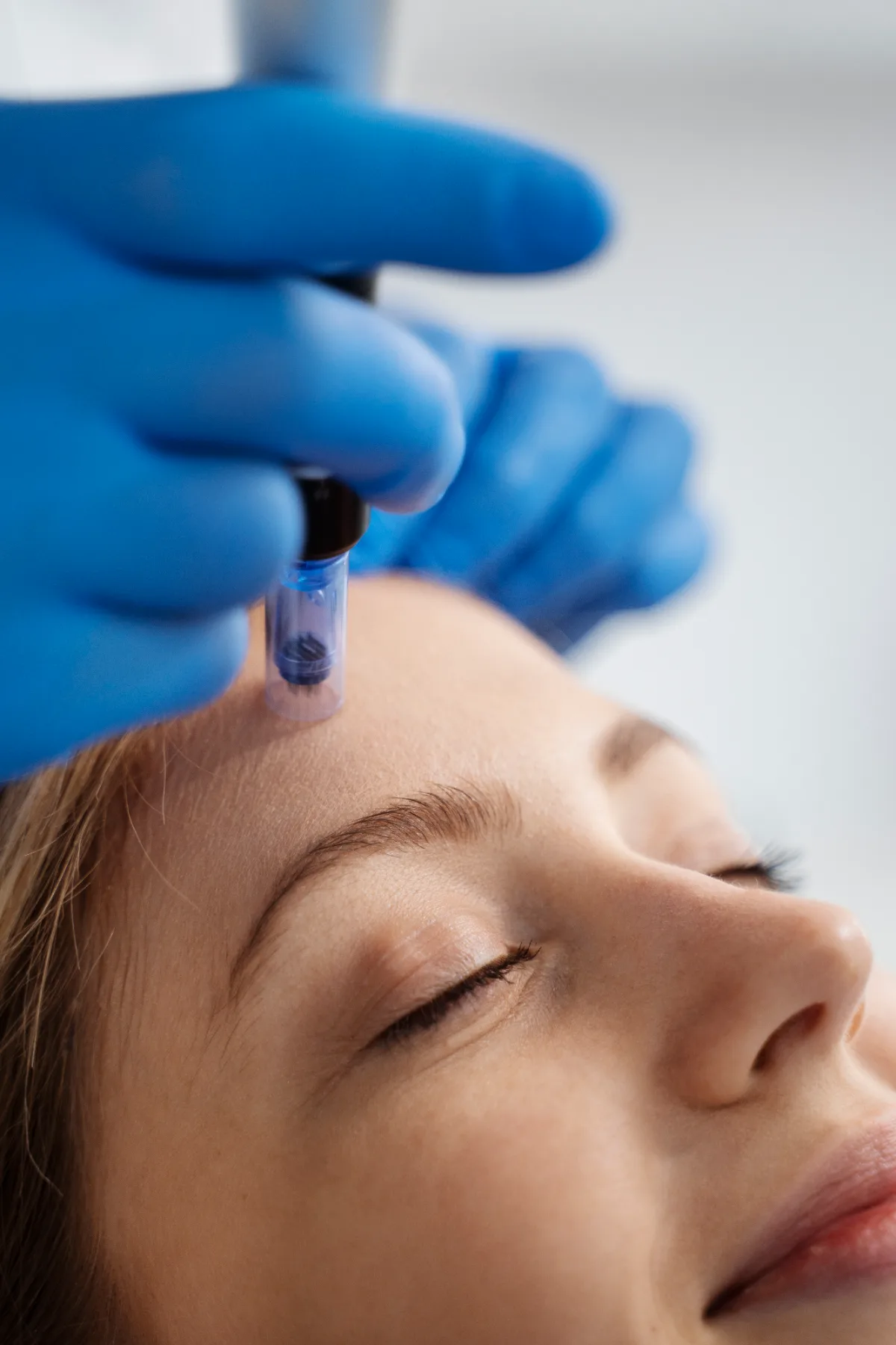 Effective Microneedling Treatment for Radiant Skin